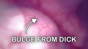 Fucked in my Pussy + Camera in my Bladder = Crazy Bulge! - Full Video on Fansly and Manyvids