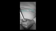 Urethral insertion with various toothbrushes. During masturbation.