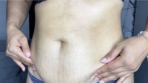 Stretch marks on the stomach