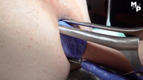 Enormous anal stretching