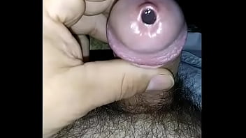 Gaping hole of 2 min long ooze