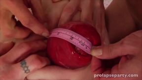 Prolapse Measure