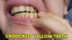 Yellow Dirty Teeth Cleaning – Food Stuck, Crooked Teeth & Close Up Mouth Fetish