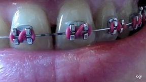 My teeth with brazes on to cam mp4