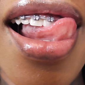 Black girl teeth brace fetish!