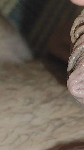 Detaching the Foreskin From the Glans Slowly.