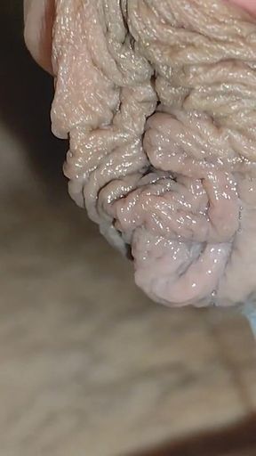 Detaching the Foreskin From the Glans Slowly.