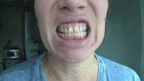 Dental fillings on my teeth mf