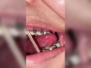 Mira que tanto metal tengo en mi boca ????