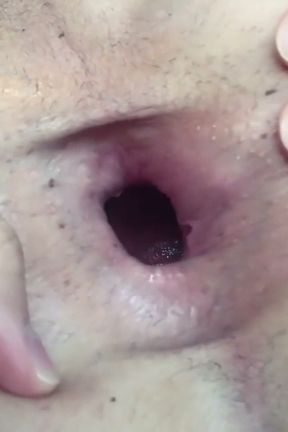 Close Gape Hole