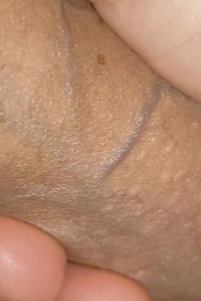 Amazing Dilator Vessel Has Disproportionate Increase.