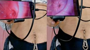 The Deepest Endoscopy Yet