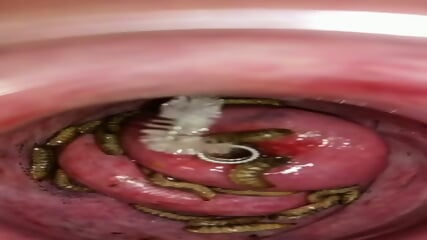 Cervix POV