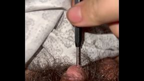 Drill bit in micro penis urethra