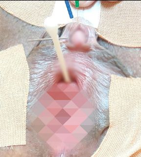 Needle **** on the clitoris.