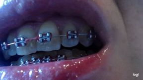 Teeth with brazes on me No audio No sound mp4