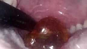Endoscopic swallowing: view of the gummy's journey from the mouth to the stomach