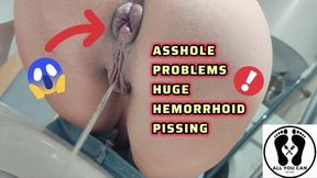 PISSING WITH A HUGE HEMORRHOID IN MY ASS ANAL PROBLEMS