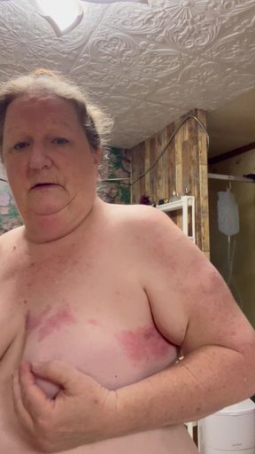 Bad Case of Shingles