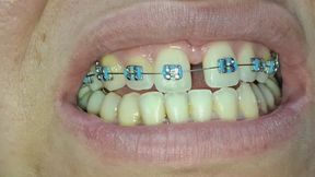 The imperfections of my teeth with my braces