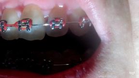 My teeth with brazes in big close up No audio No sound mp4