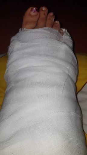 Wiggling My Toes in Cast