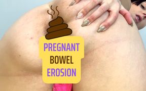 Pregnant Bowel Erosion