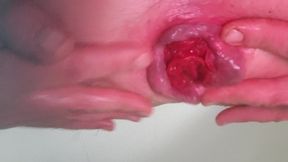 Rosebud Prolaps