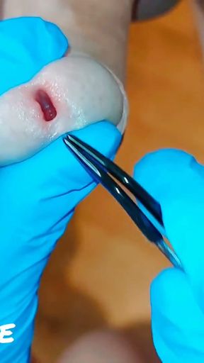CFNM Nurse Part 3: Foreskin Stretching Treatment (Milking-time)   Clip 1
