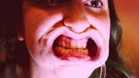 Preparing for Invisible Aligners