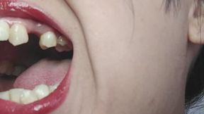 Guess how many molars l'm missing