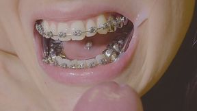 EPIC Braces HERBST and expander handjob