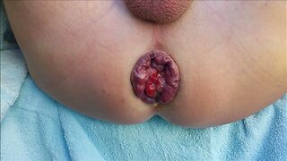 Self anal fisting my dirty prolapse
