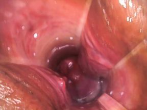 Endoscope Examination of my Pussy and Cervix