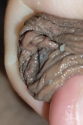 Detaching the Foreskin From the Glans Slowly.