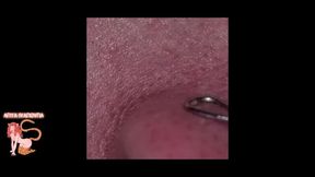 Amateur Extractions