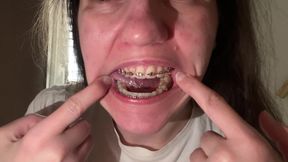 Licking Your Braces with Your Tongue