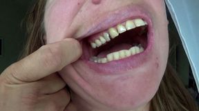Dental fillings on my teeth 2 c