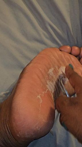 Peeling my Soles- Extended black woman picks skin from feet