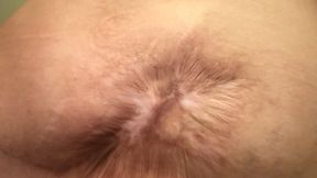 Abdominoplasty Scar Botched body rejected tummy tuck results in epic, beautiful, and one of a kind large scar. FIrst Clip…come relive my journey copy 1