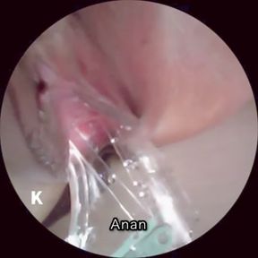 [Ultra-compact camera] I explored the inside of the vagina with Cusco.