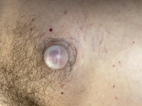 Supple Cups filling up with Serous fluid
