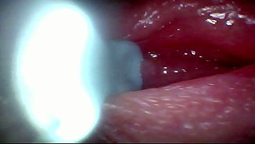 Endoscope camera captures moment of male ejaculation