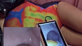 Digesting a Mandarin: Endoscopic Stomach View (Part 1)