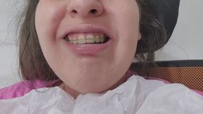 Retainers & Drooling Compilation: Chubby Girl Wearing Retainers and Drooling POV