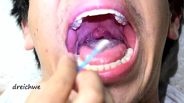 Touching the uvula with swabs