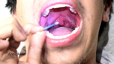 Touching the uvula with swabs