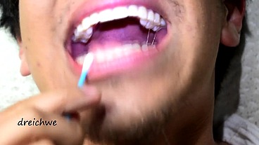 Touching the uvula with swabs